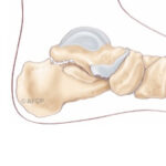 Arthrose Soutalienne