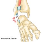 Entorse Cheville
