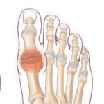 Hallux Rigidus